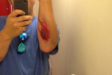 Arm wound