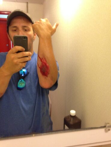 Arm wound