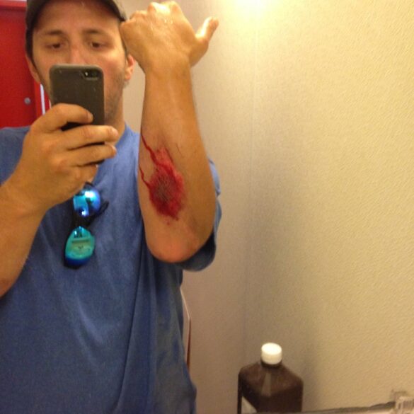 Arm wound